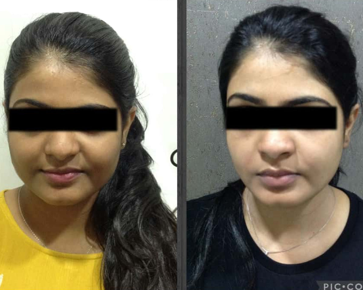 before after whitening injection