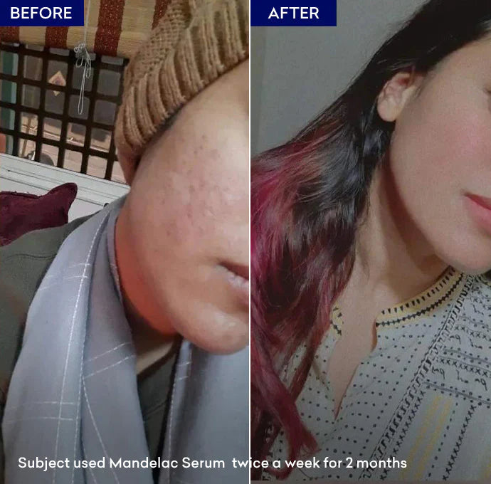 MANDELAC SERUM before after