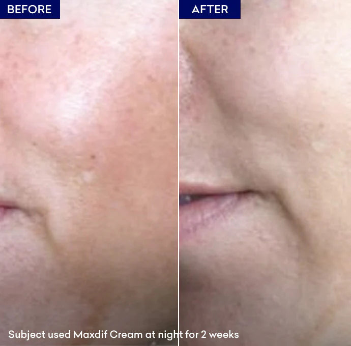 maxdif cream before after