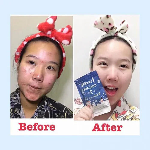 whitening-capsule-before-after