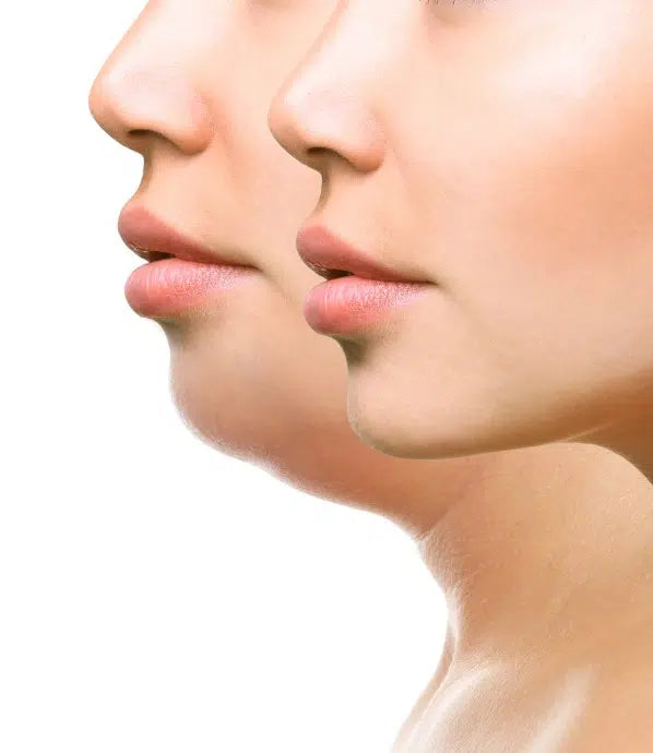 Lipo Lab Fat Dissolve Injections